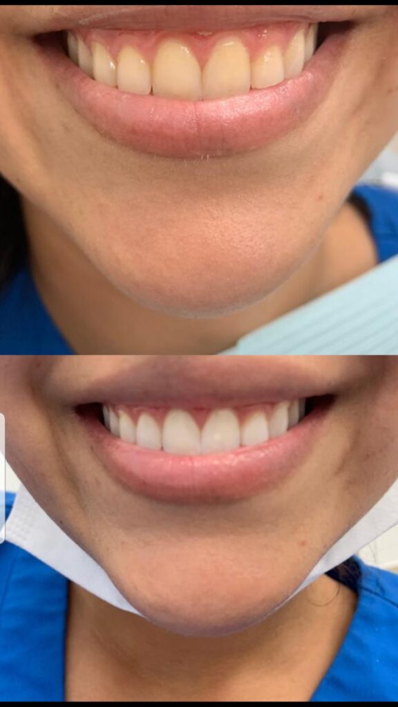 zoom teeth whitening aventura fl zoom teeth whitening aventura fl